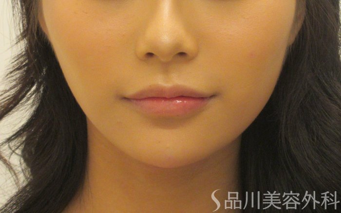 症例NO.71689のAFTER写真
