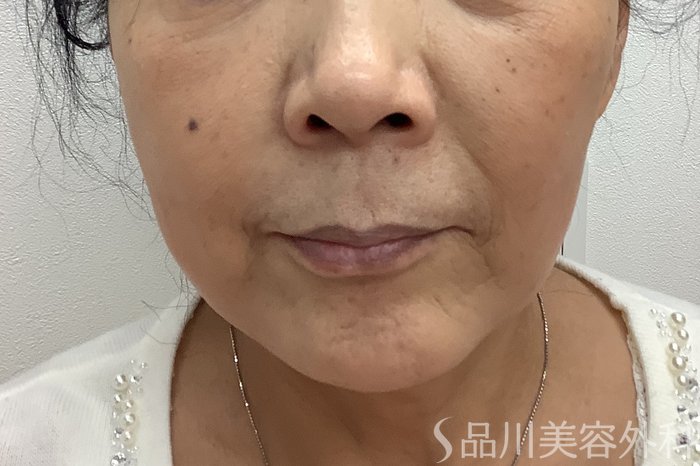 症例NO.62155のBEFORE写真