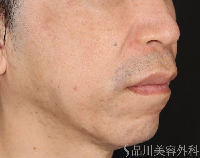 症例NO.71196のAFTER写真
