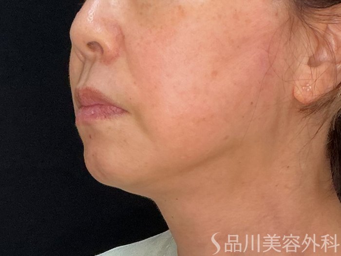 症例NO.71826のAFTER写真