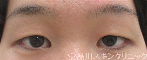 症例NO.27864のBEFORE写真