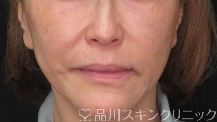 症例NO.70826のAFTER写真