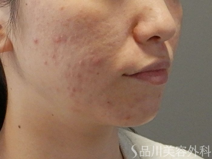 症例NO.71675のBEFORE写真