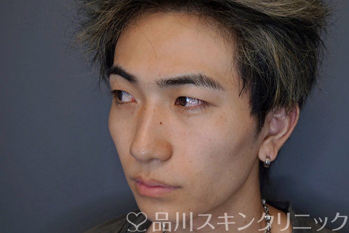 症例NO.73977のBEFORE写真