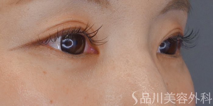 症例NO.69620のBEFORE写真