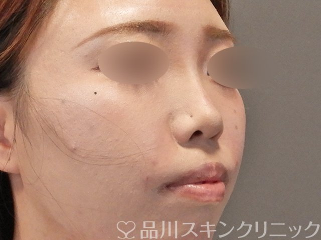 症例NO.75251のAFTER写真