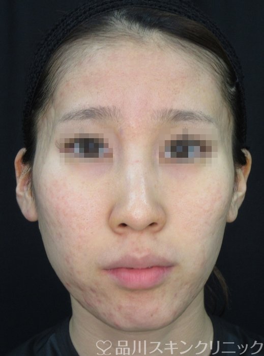 症例NO.72056のBEFORE写真