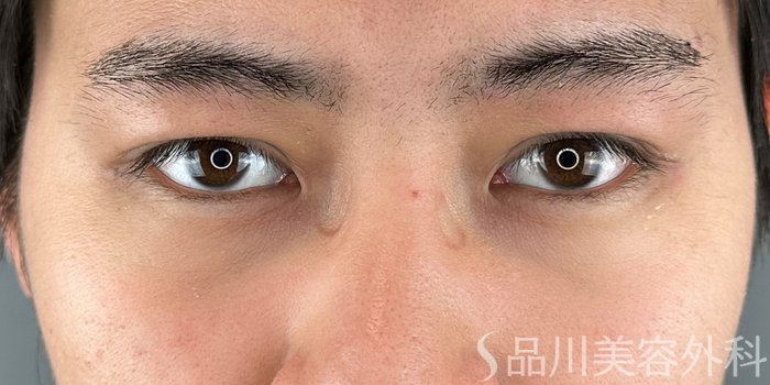 症例NO.69284のAFTER写真