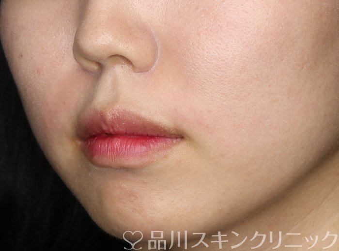 症例NO.73086のAFTER写真