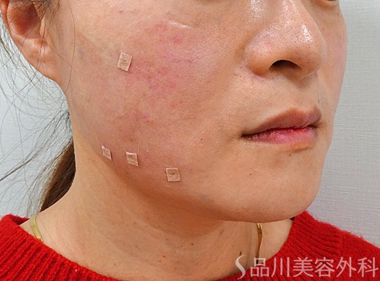 症例NO.73698のAFTER写真