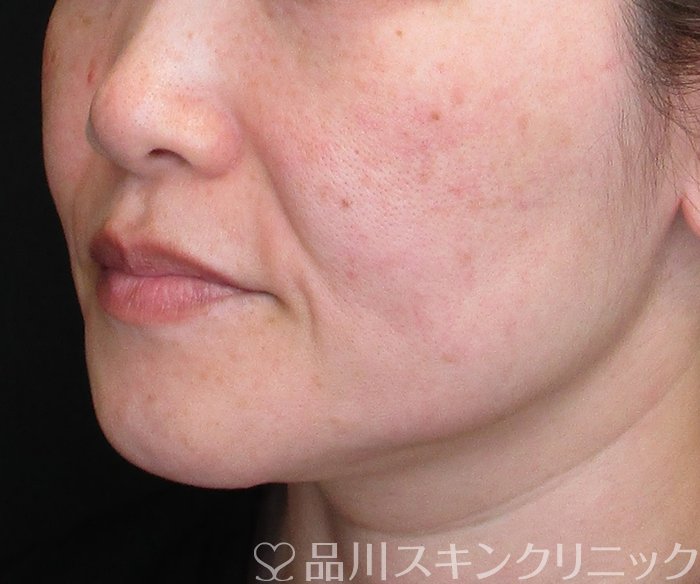 症例NO.75071のAFTER写真
