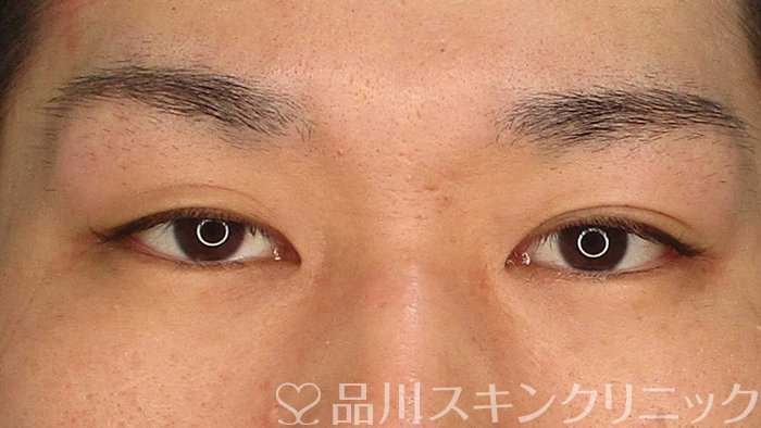 症例NO.63044のBEFORE写真