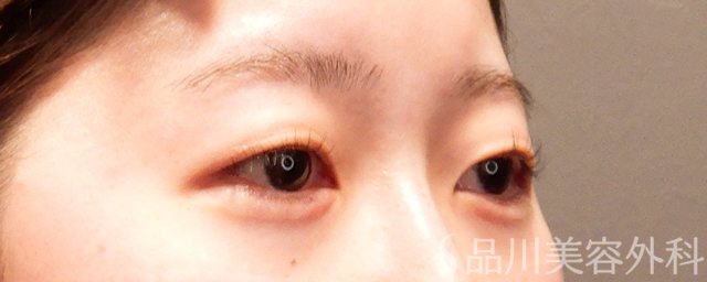 症例NO.69366のAFTER写真