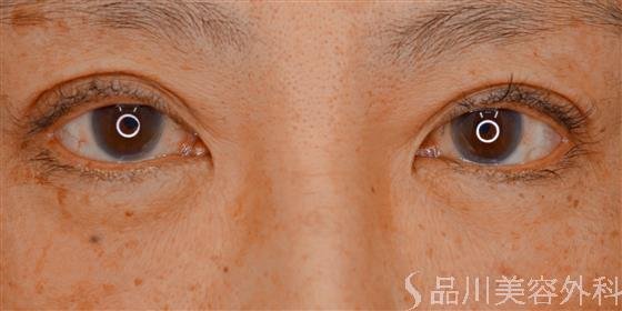 症例NO.60490のAFTER写真