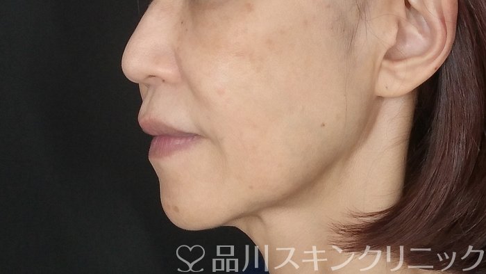 症例NO.72477のBEFORE写真