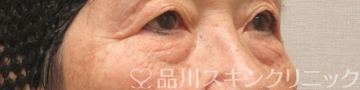 症例NO.75343のBEFORE写真