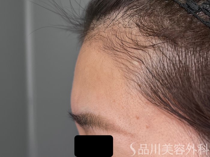 症例NO.70502のBEFORE写真