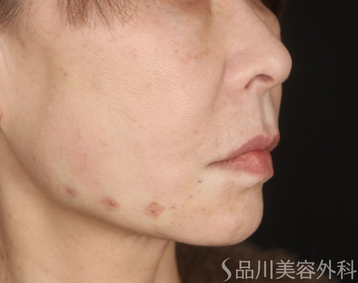 症例NO.73249のAFTER写真