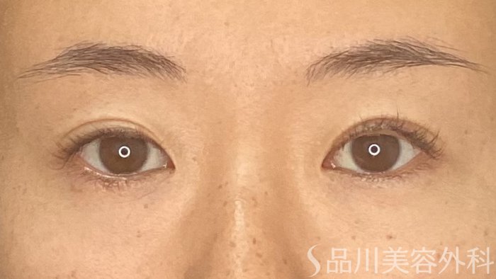 症例NO.74561のBEFORE写真