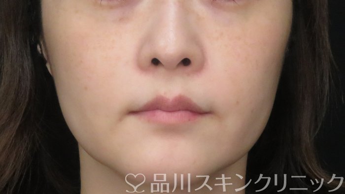 症例NO.71332のBEFORE写真