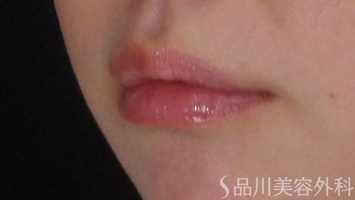 症例NO.67957のBEFORE写真