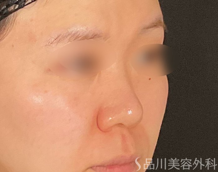 症例NO.74788のBEFORE写真