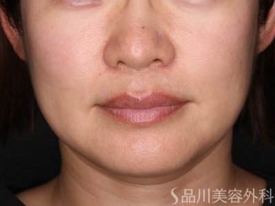 症例NO.71369のBEFORE写真