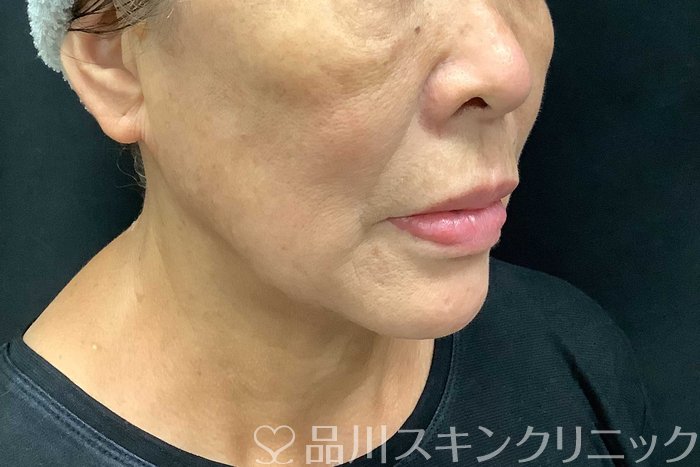 症例NO.69776のAFTER写真