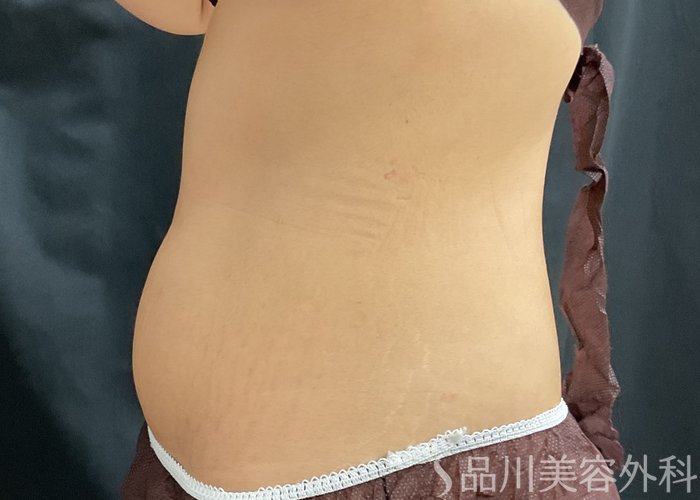 症例NO.75368のBEFORE写真