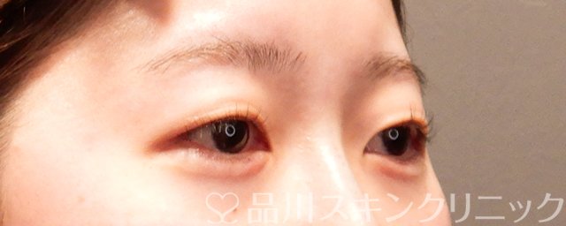 症例NO.69366のAFTER写真