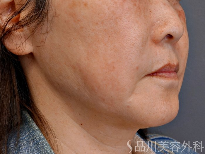 症例NO.73803のBEFORE写真
