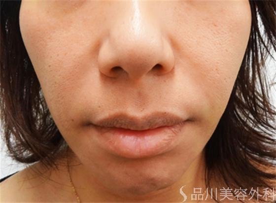 症例NO.18768のAFTER写真