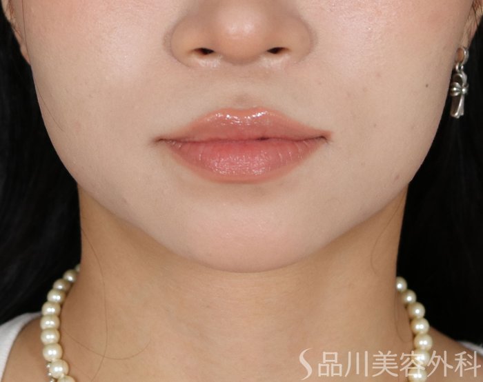 症例NO.72185のAFTER写真