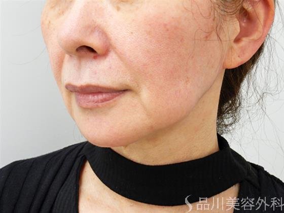 症例NO.50777のBEFORE写真