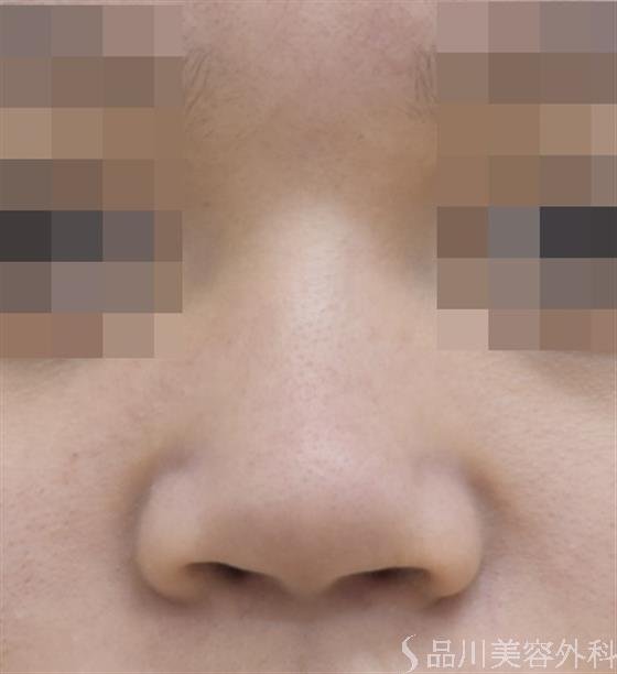 症例NO.46180のBEFORE写真