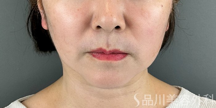 症例NO.70957のBEFORE写真