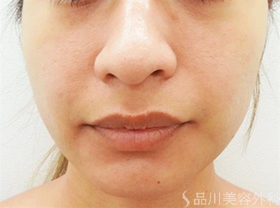 症例NO.33420のAFTER写真