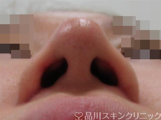 症例NO.34269のAFTER写真