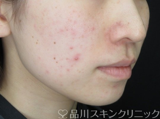 症例NO.70265のBEFORE写真