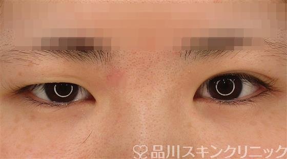 症例NO.50638のBEFORE写真