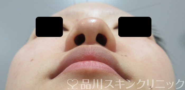 症例NO.73980のBEFORE写真