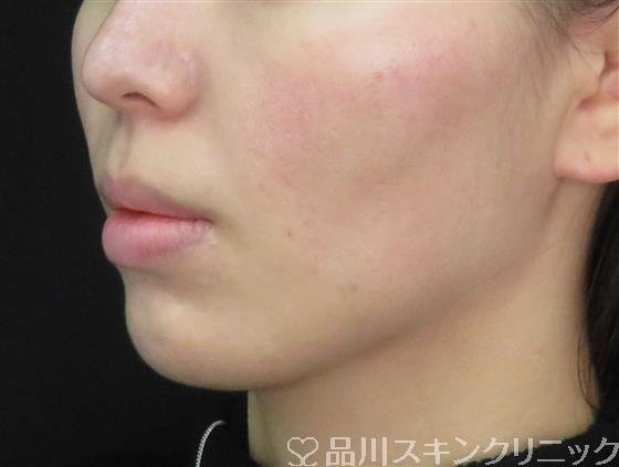 症例NO.61906のAFTER写真