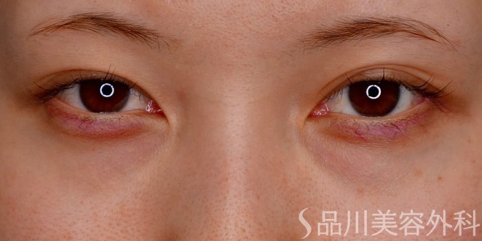 症例NO.73529のBEFORE写真