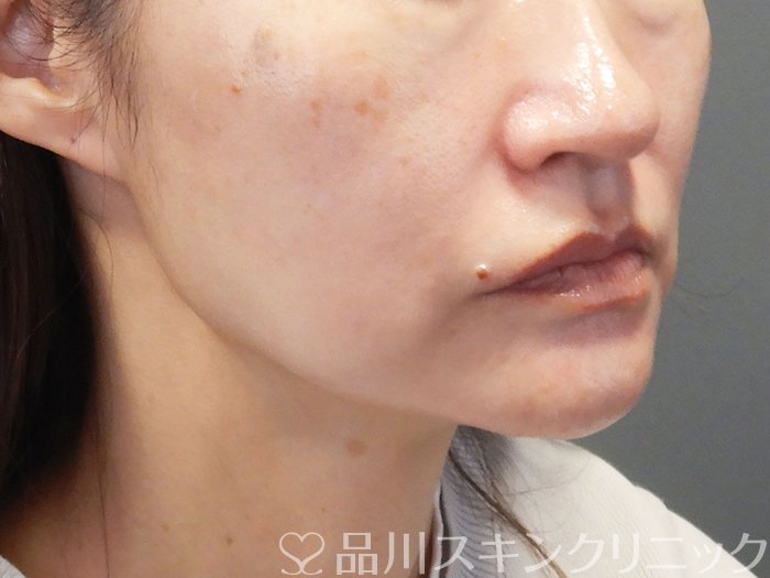 症例NO.72393のAFTER写真