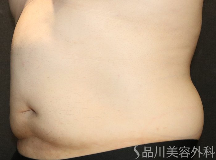 症例NO.74500のBEFORE写真