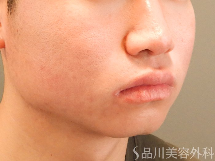 症例NO.70245のAFTER写真