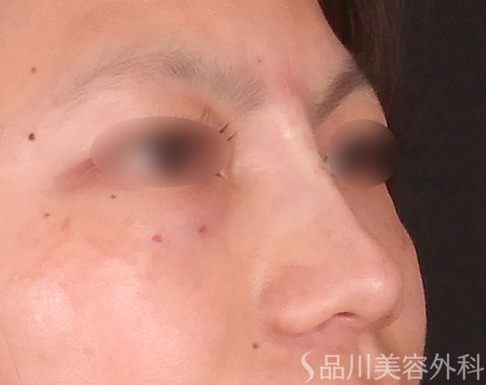 症例NO.70171のAFTER写真