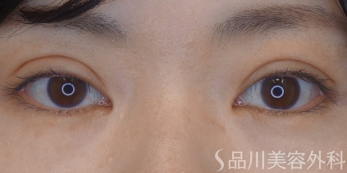 症例NO.72320のAFTER写真