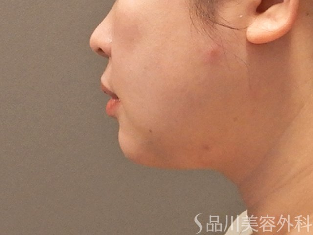 症例NO.71928のAFTER写真