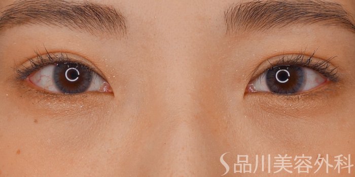 症例NO.72352のAFTER写真